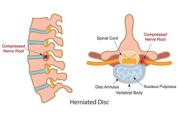 Remedies to Relieve Slip Disk Pain