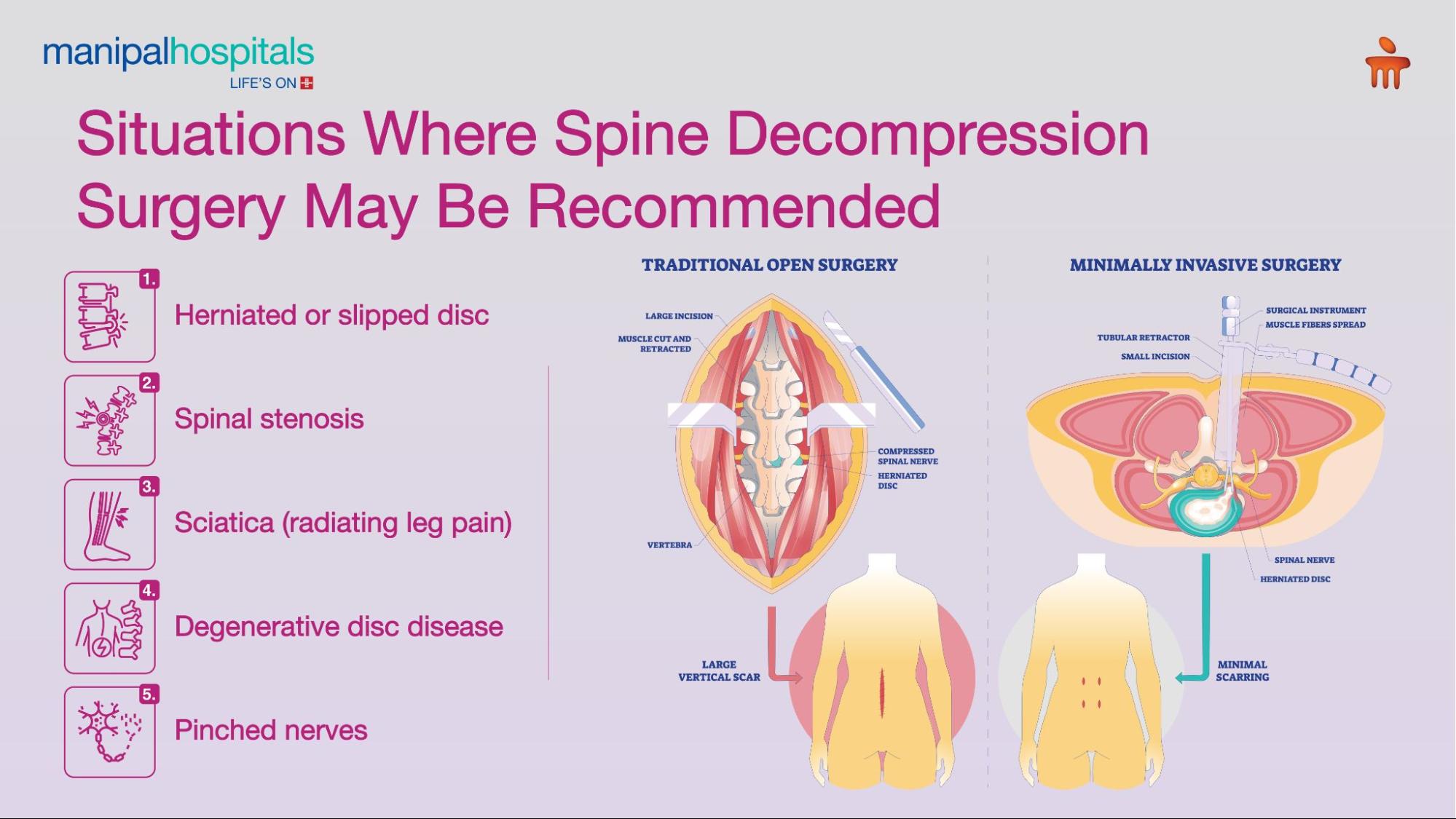 Spinal Decompression Surgery