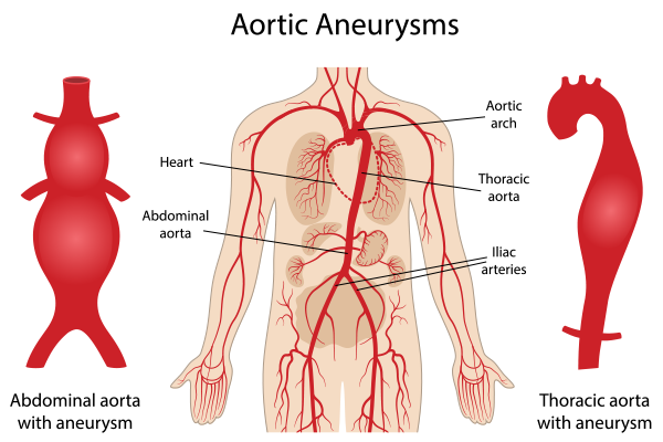Types of Aneurysm and Its Symptoms, Causes, & Treatment