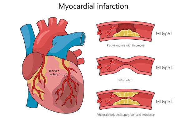 Heart block types and treatment