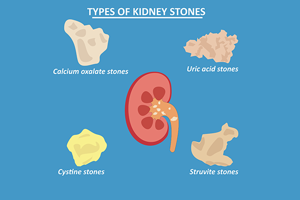Common Kidney Stone Types and Their Treatments