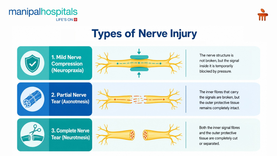 Types of Nerve Injury: Causes, Symptoms & Recovery