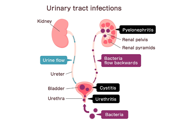 UTI causes, symptoms, and treatment