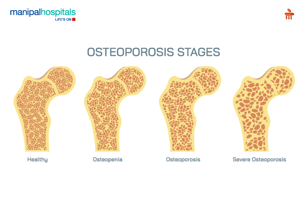 understanding-osteoporosis-causes-symptoms-prevention