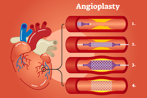Understanding Angioplasty: Procedure, Recovery & Success Rates