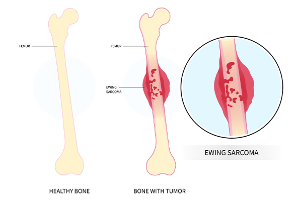 bone cancer symptoms