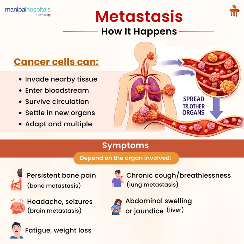 What Is Metastasis? A Clear, In-Depth Guide for Patients and Families