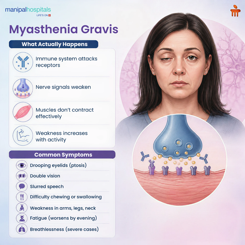 What Is Myasthenia Gravis? Definition, Signs, and Medical Overview