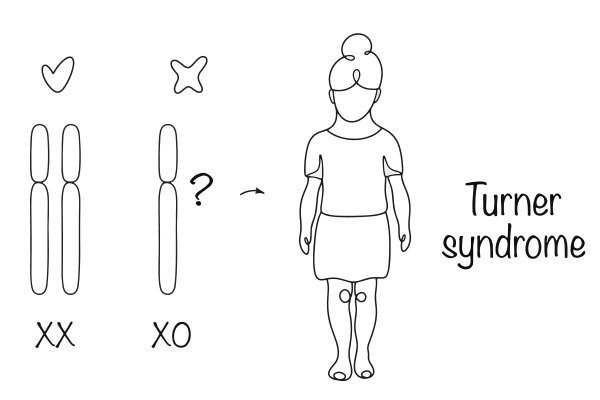 turner-syndrome-symptoms-causes-treatment