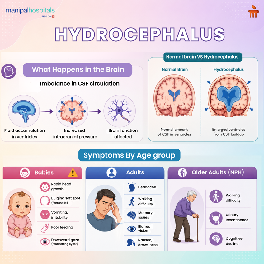 What is Hydrocephalus? Causes, Symptoms & Treatment Options Explained