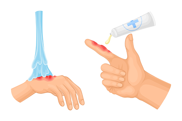 What to Do Immediately After a Skin Burn Injury