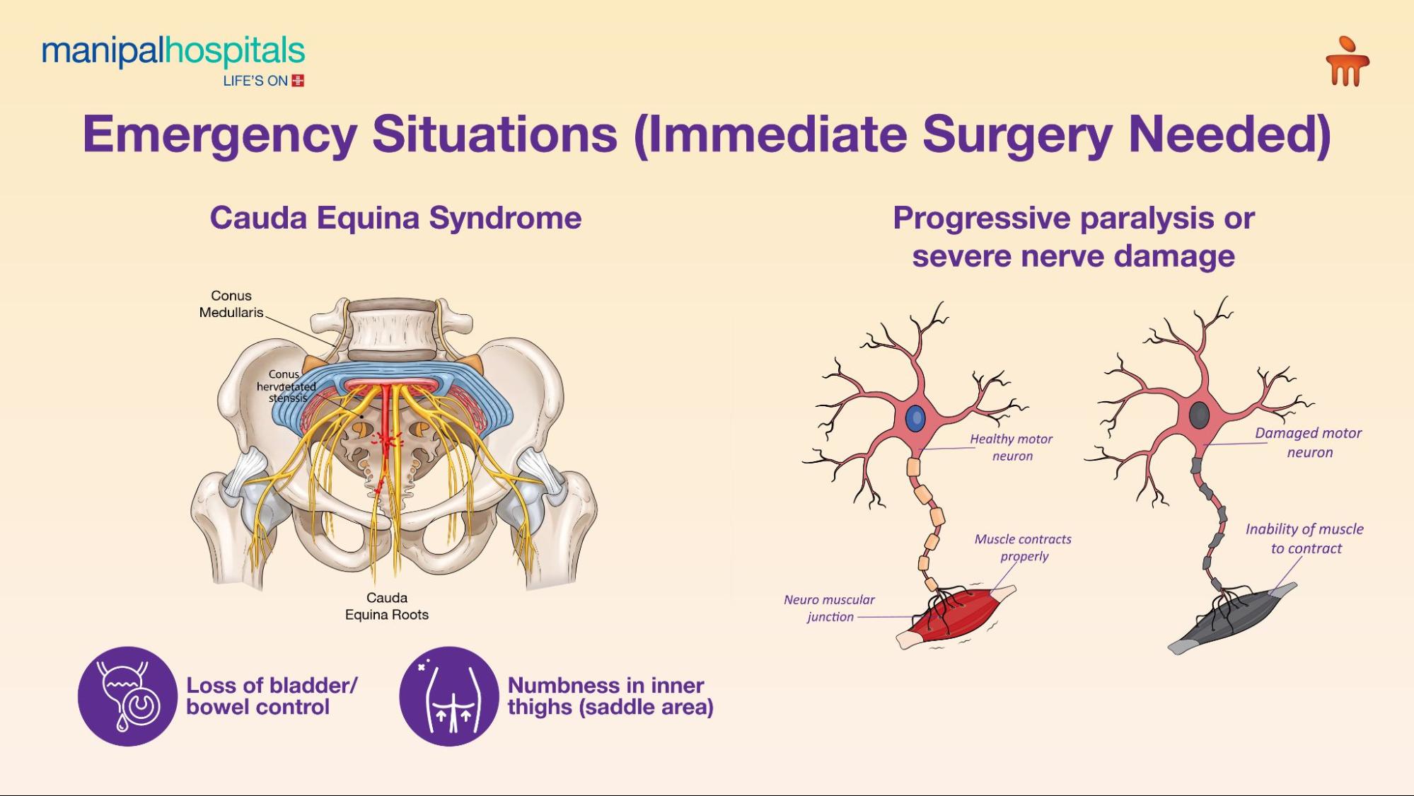 Spine surgery for lower back pain when needed