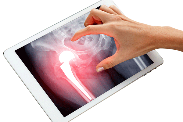 Recovery time after knee or hip replacement surgery