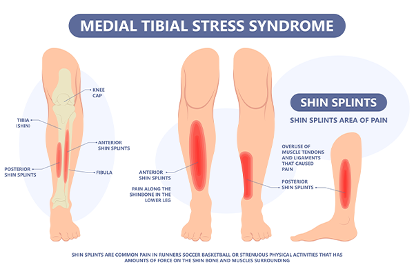 Causes and Treatments of Shin Pain After Runnin
