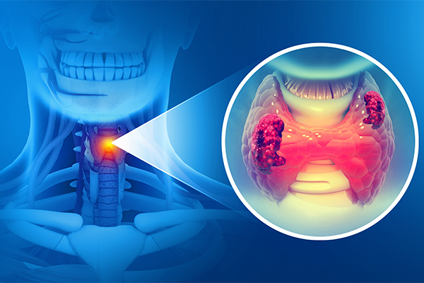 World Thyroid Day 2025: Raising Awareness for Thyroid Health