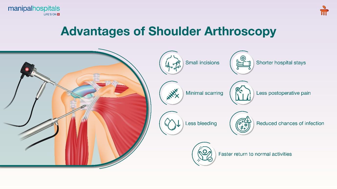 Avantages of shoulder arthroscopy
