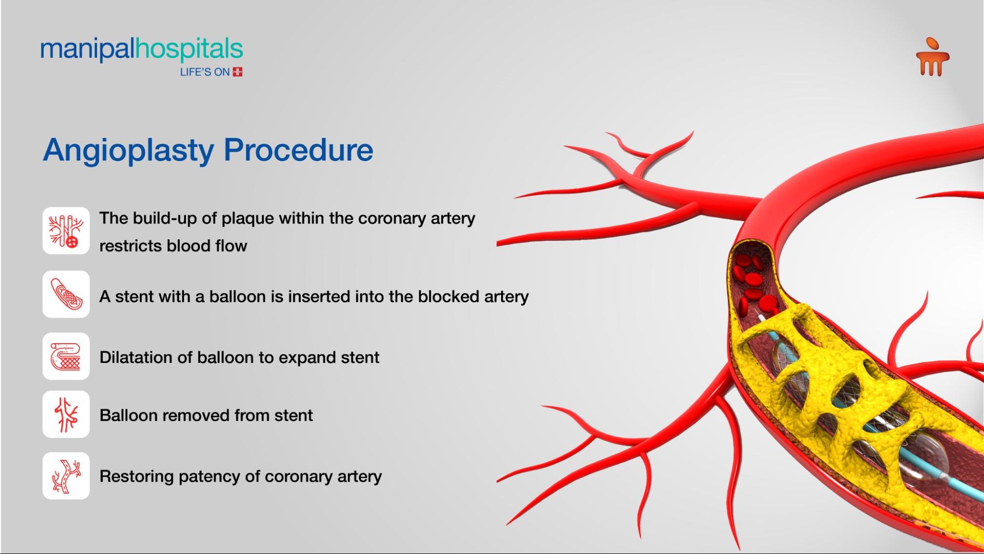 Unlocking The Potential Of Angioplasty In Cardiac Science