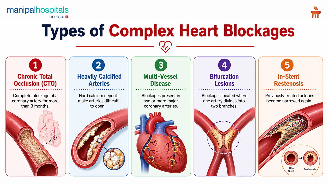 angioplasty