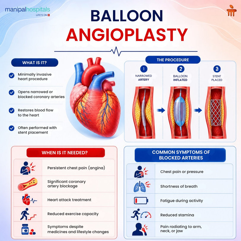 balloon-angioplasty-for-heart-disease