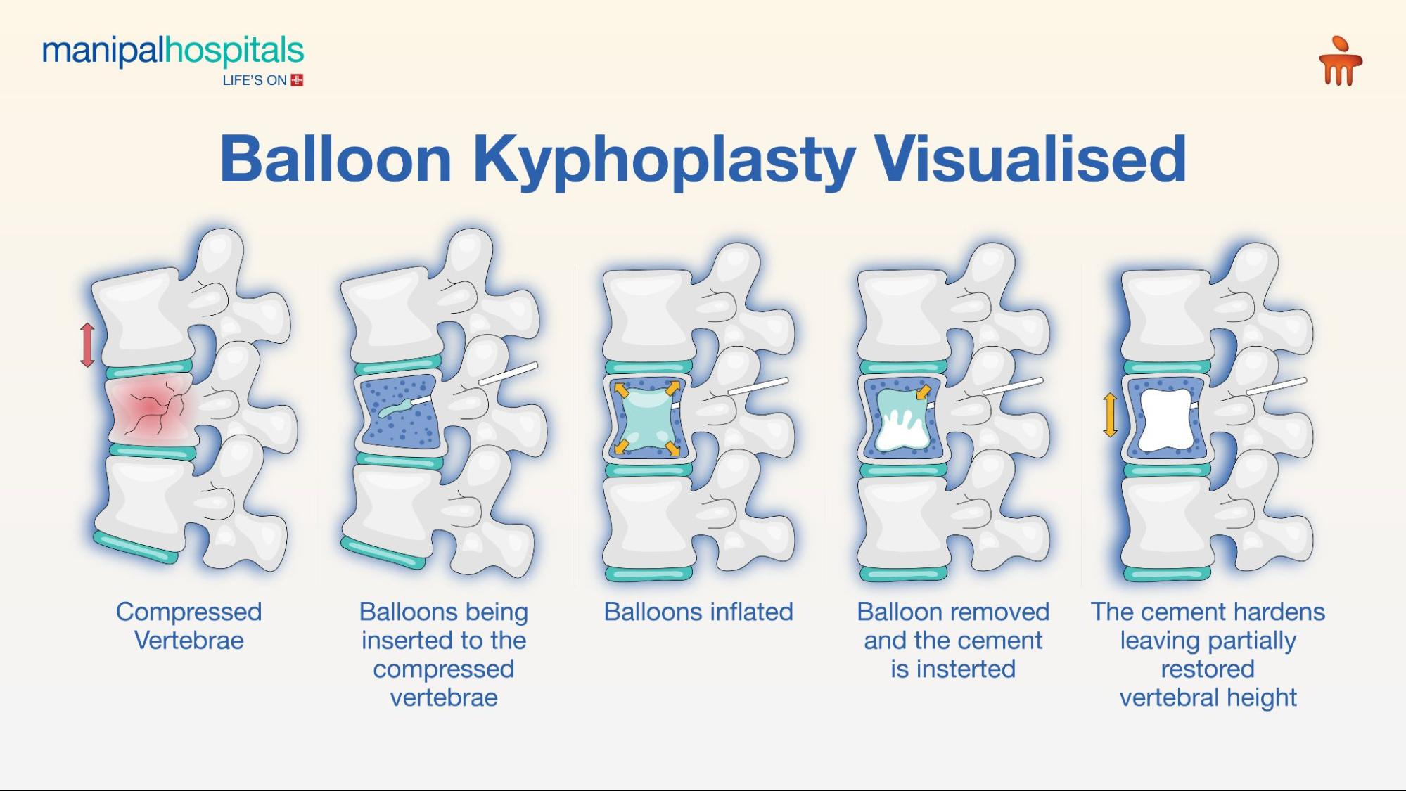  Balloon Kyphoplasty Surgery