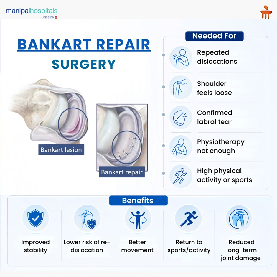 Bankart surgery