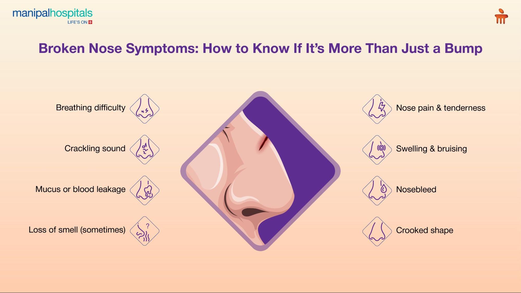 Broken nose symptoms