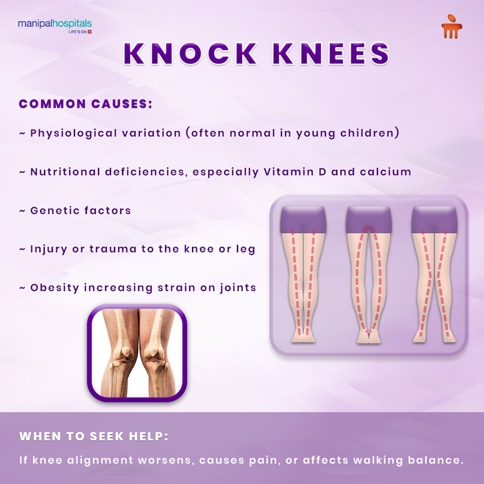 child knock knees