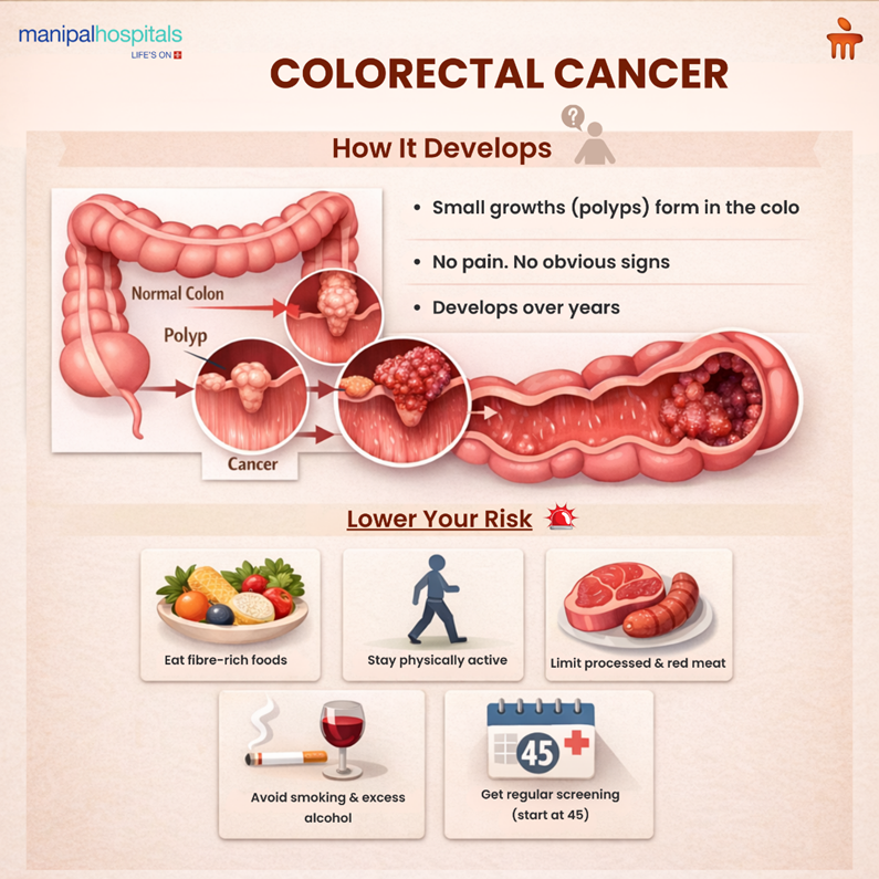 colorectal-cancer-symptoms-stages-treatment