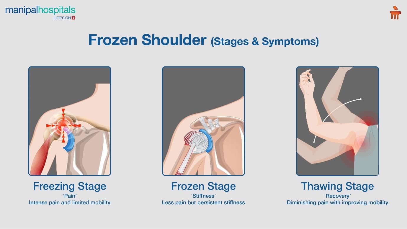 Frozen shoulder - stages and symptoms