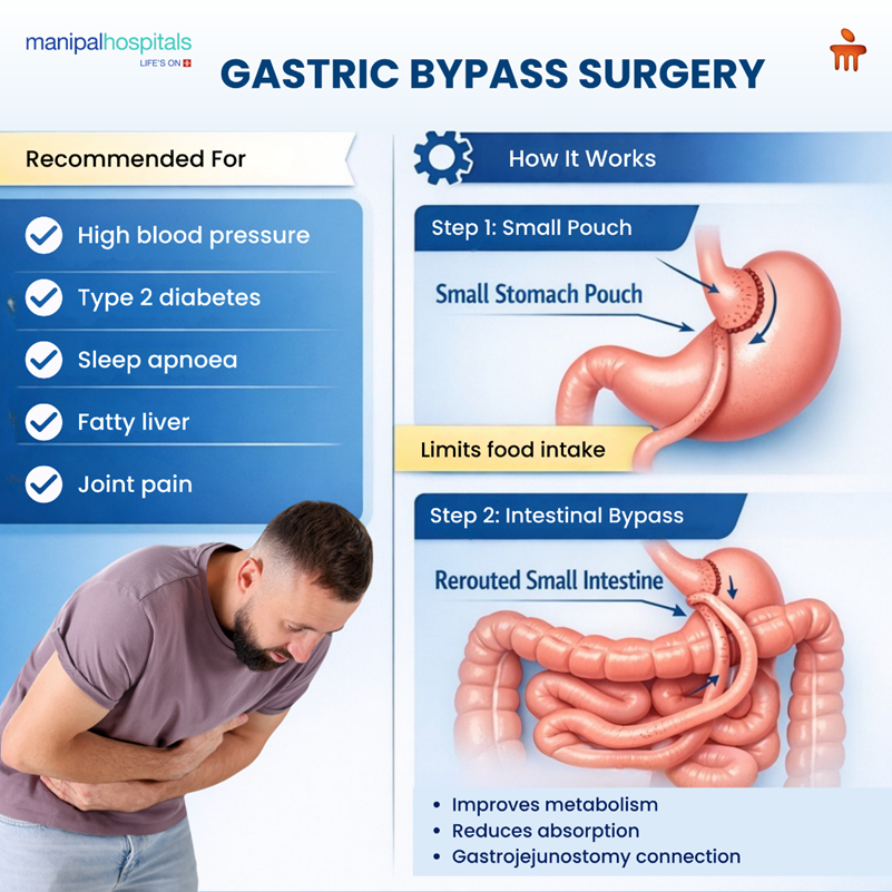 gastric-bypass-surgery-types-causes-treatment