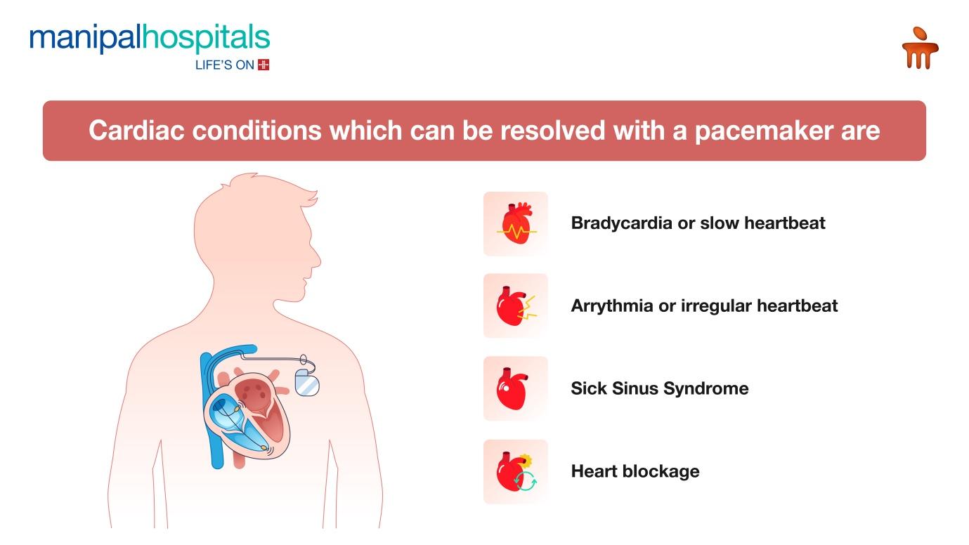 Life after pacemaker implantation recovery and care tips