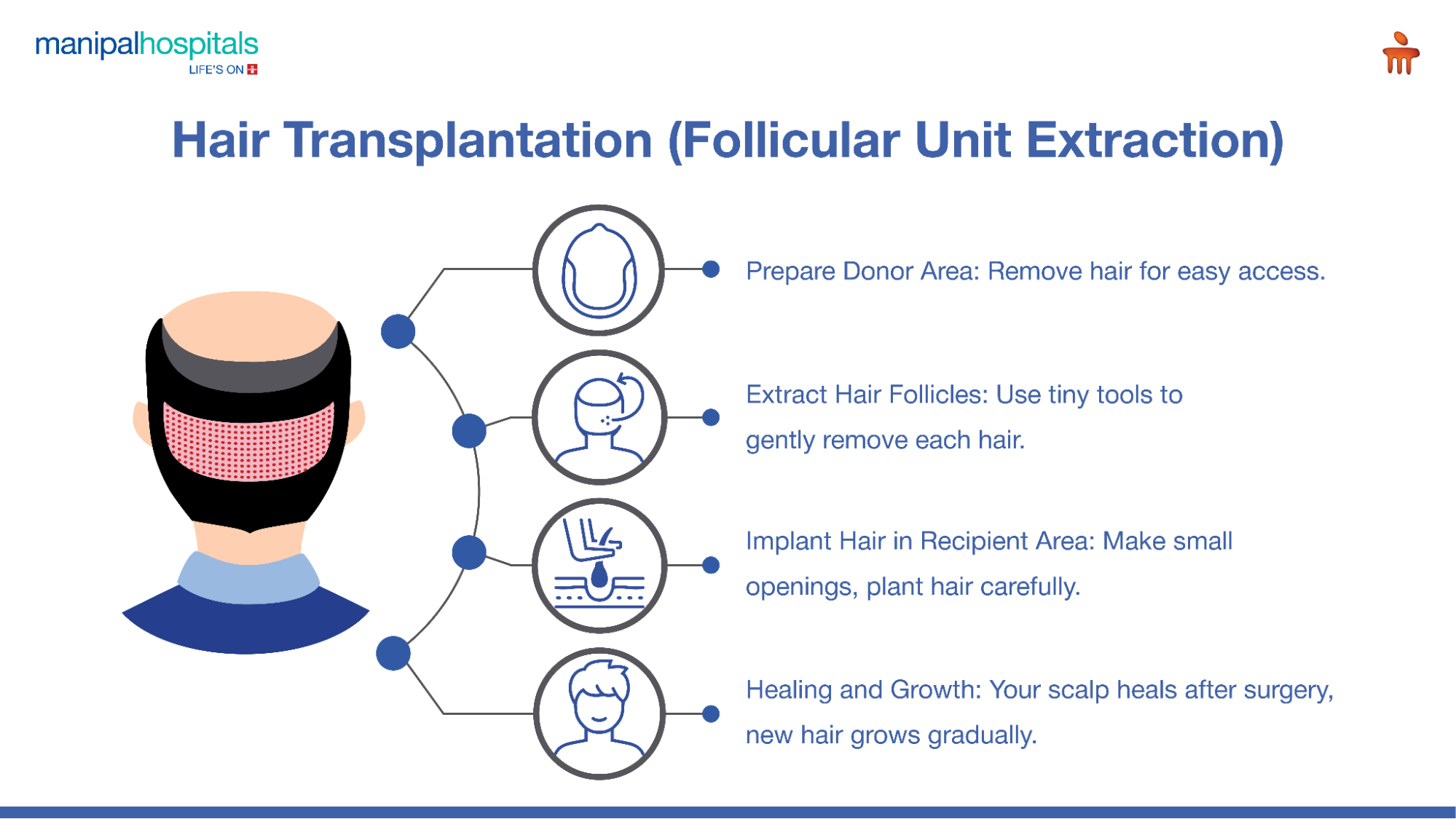Infographic showing steps to select a top hair transplant clinic—doctor’s expertise, techniques, before-after results, and patient support