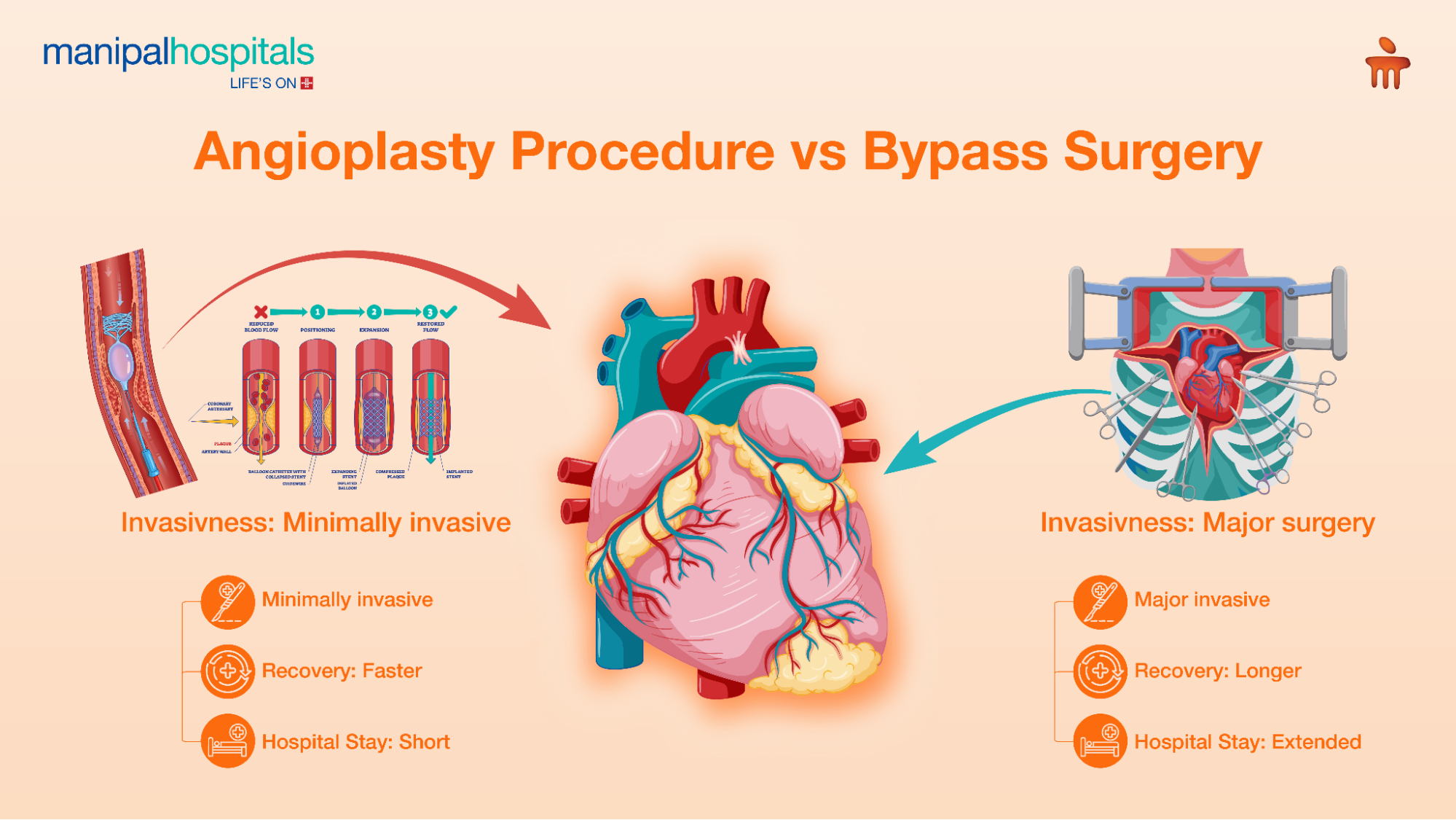 angioplasty surgery procedure