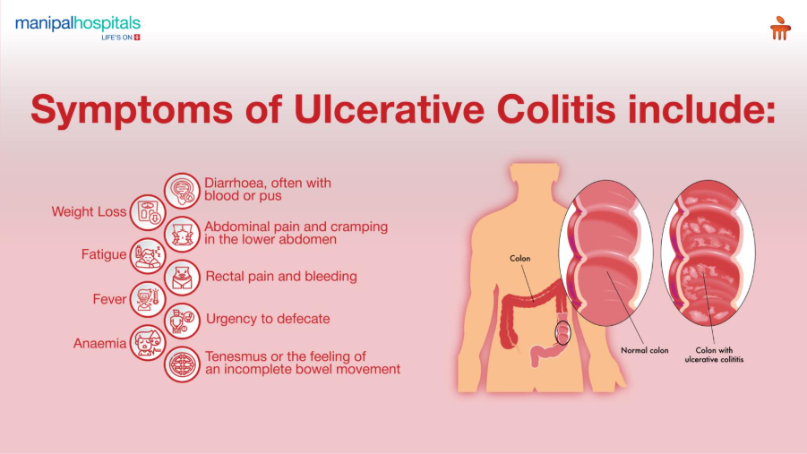 Ulcerative colitis symptoms causes and treatment