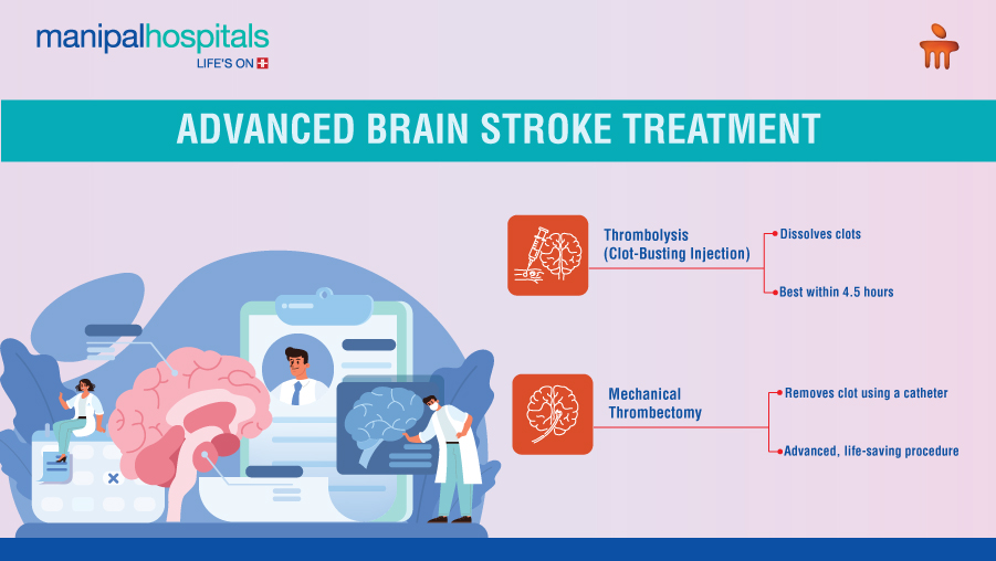 brain stroke treatment