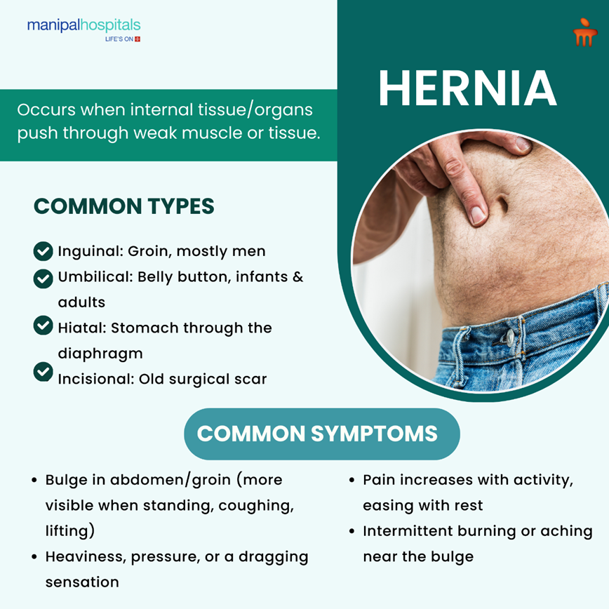 Hernia Signs You Shouldn’t Ignore