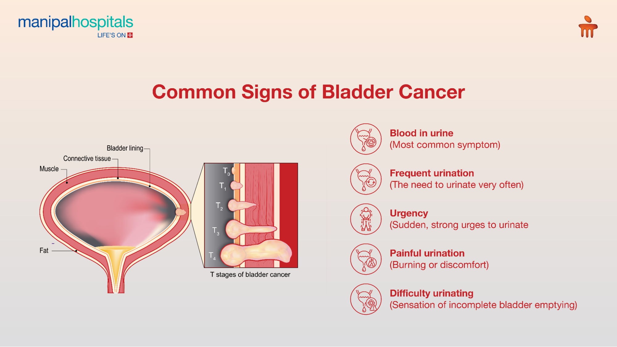 Bladder cancer