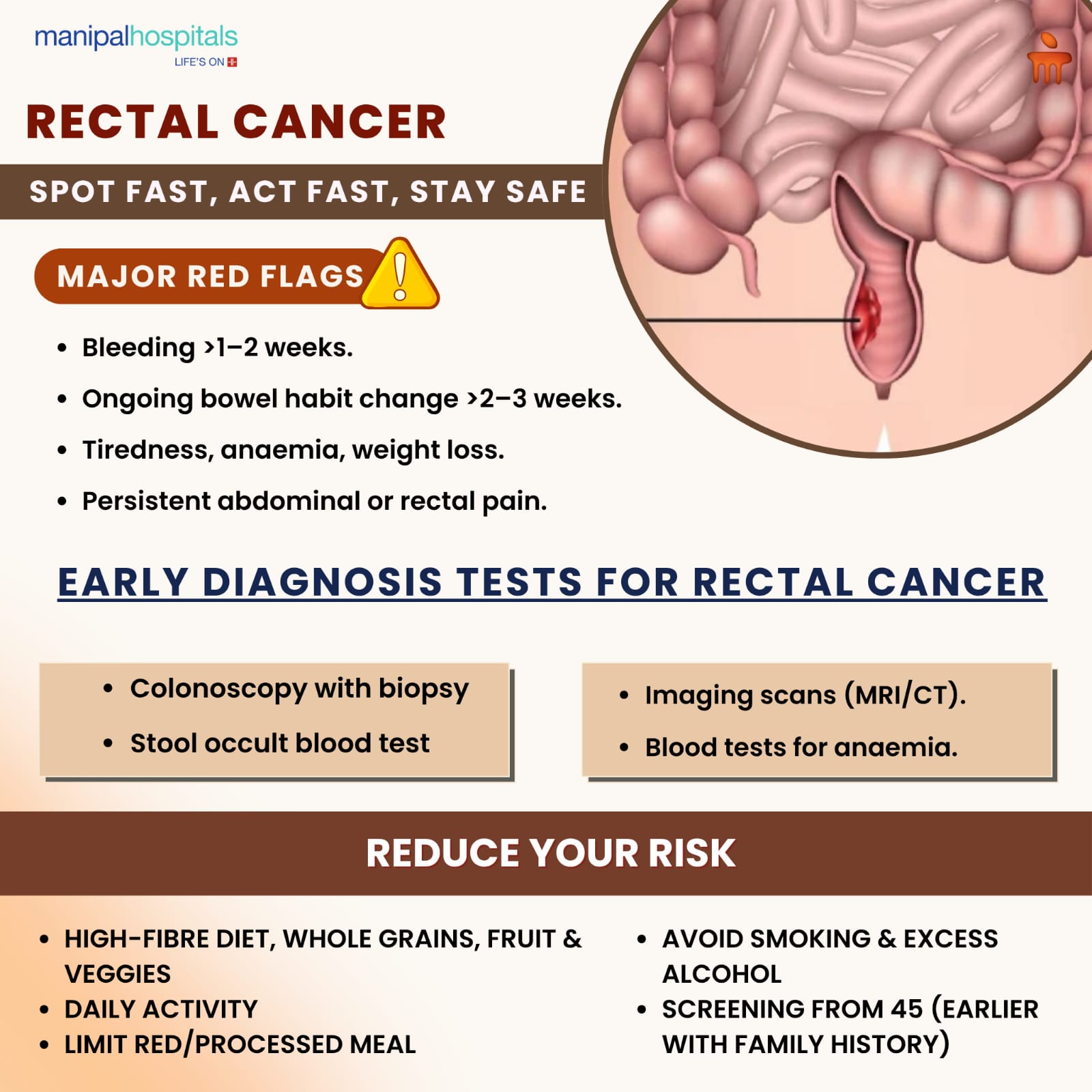 Early Signs of Rectal Cancer