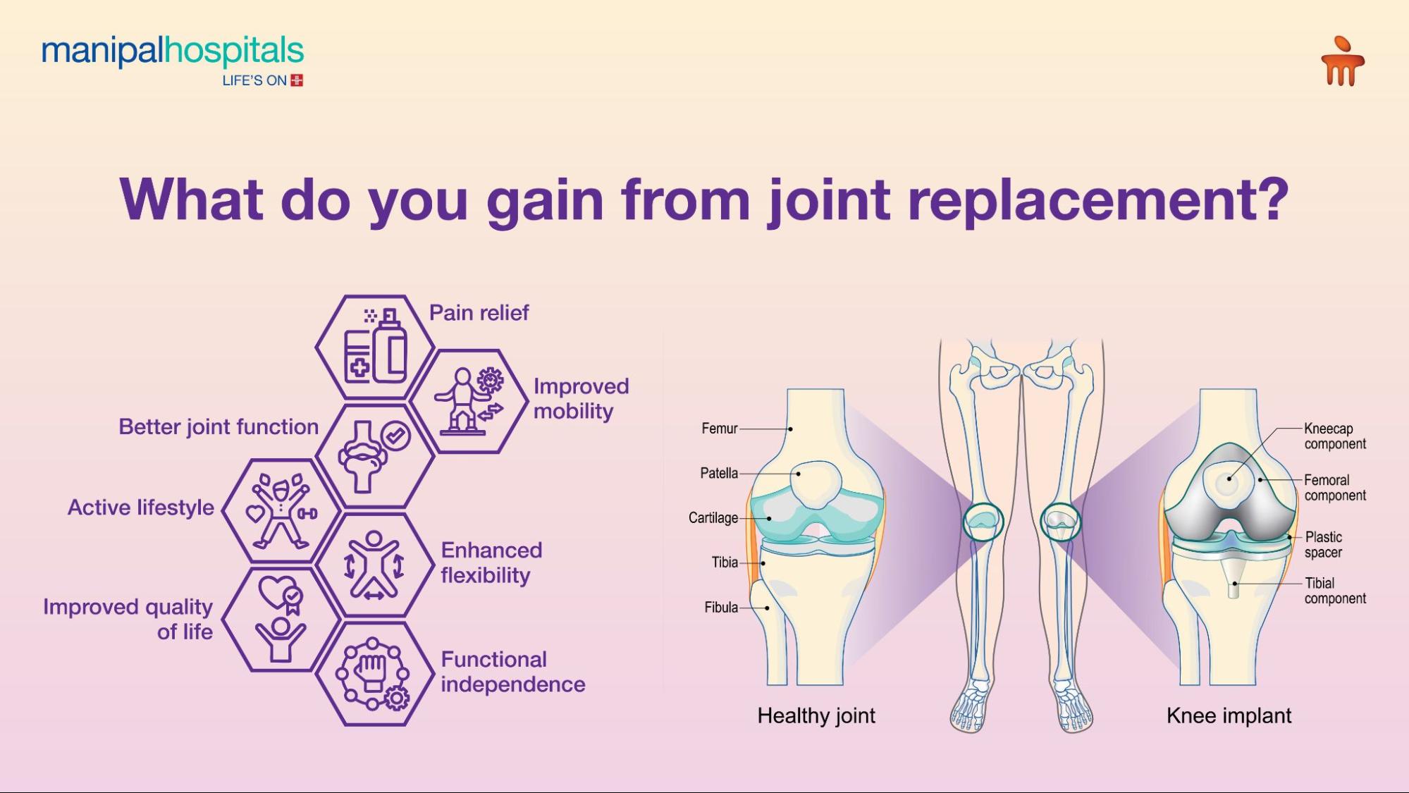 joint-replacement-surgery-when-needed