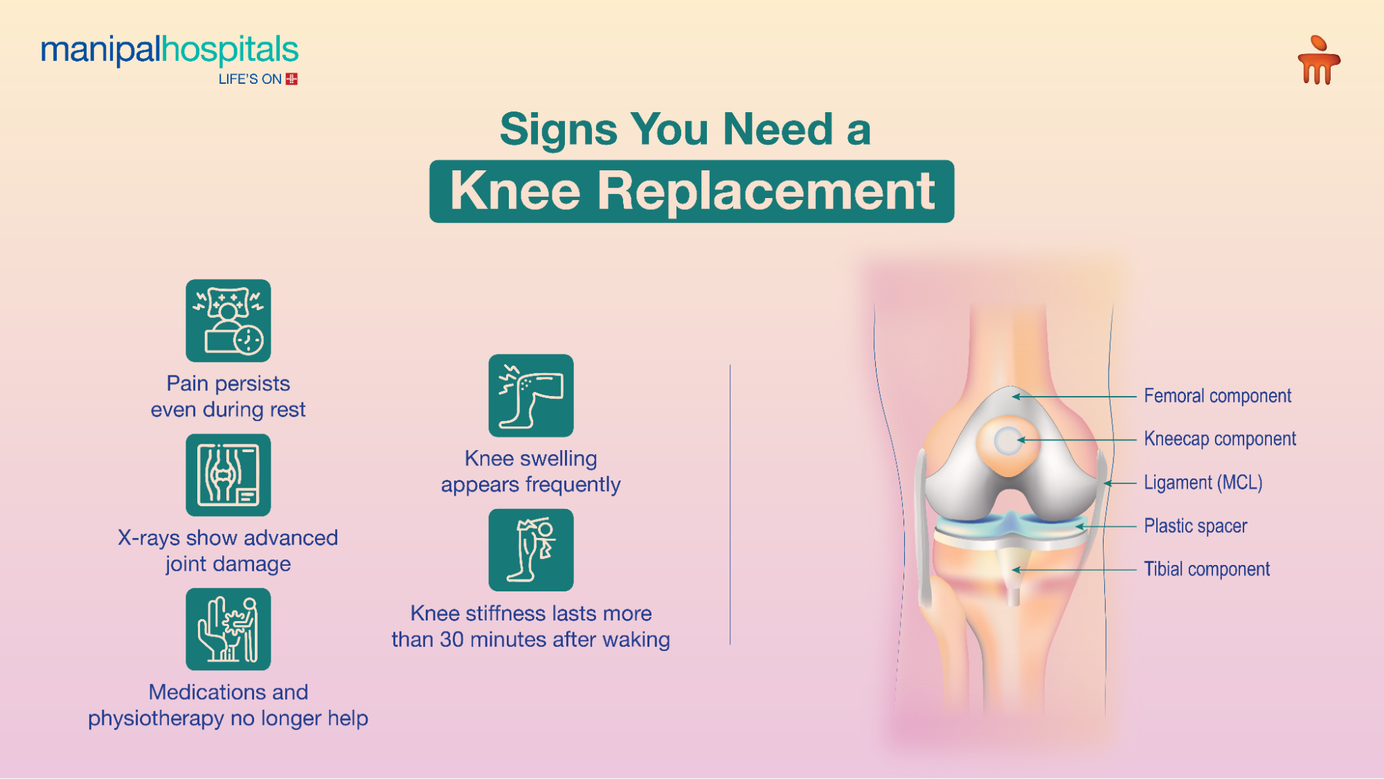 how do you know if you need a knee replacement