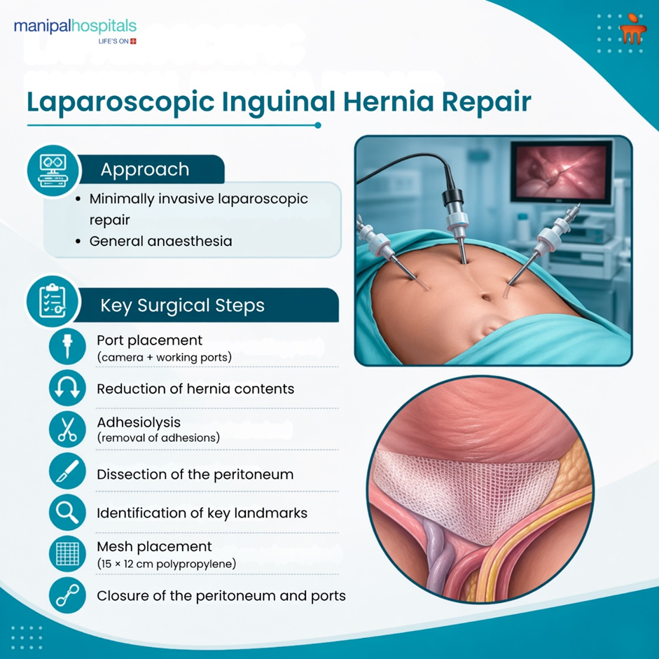 laparoscopic-right-inguinal-hernia-management