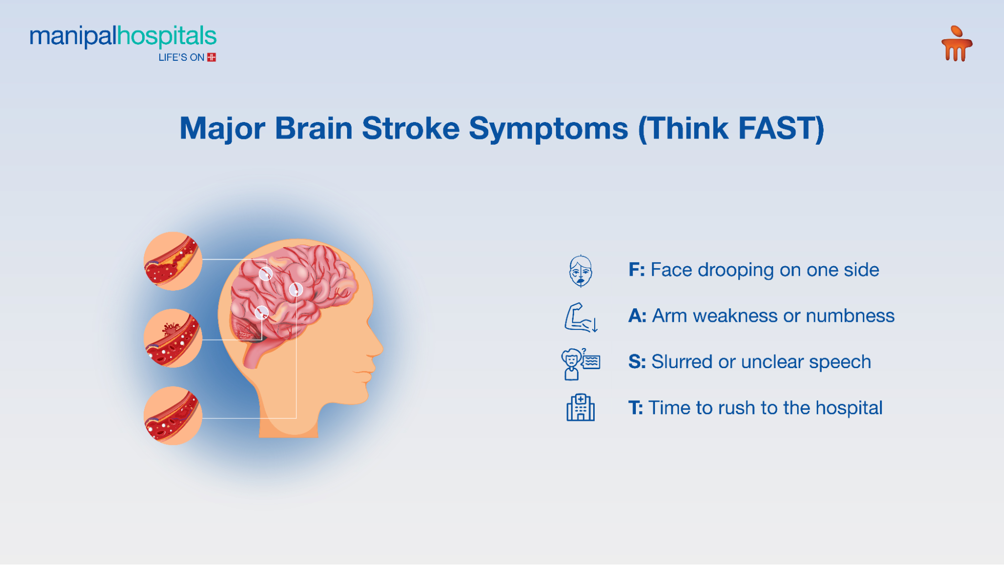 brain stroke