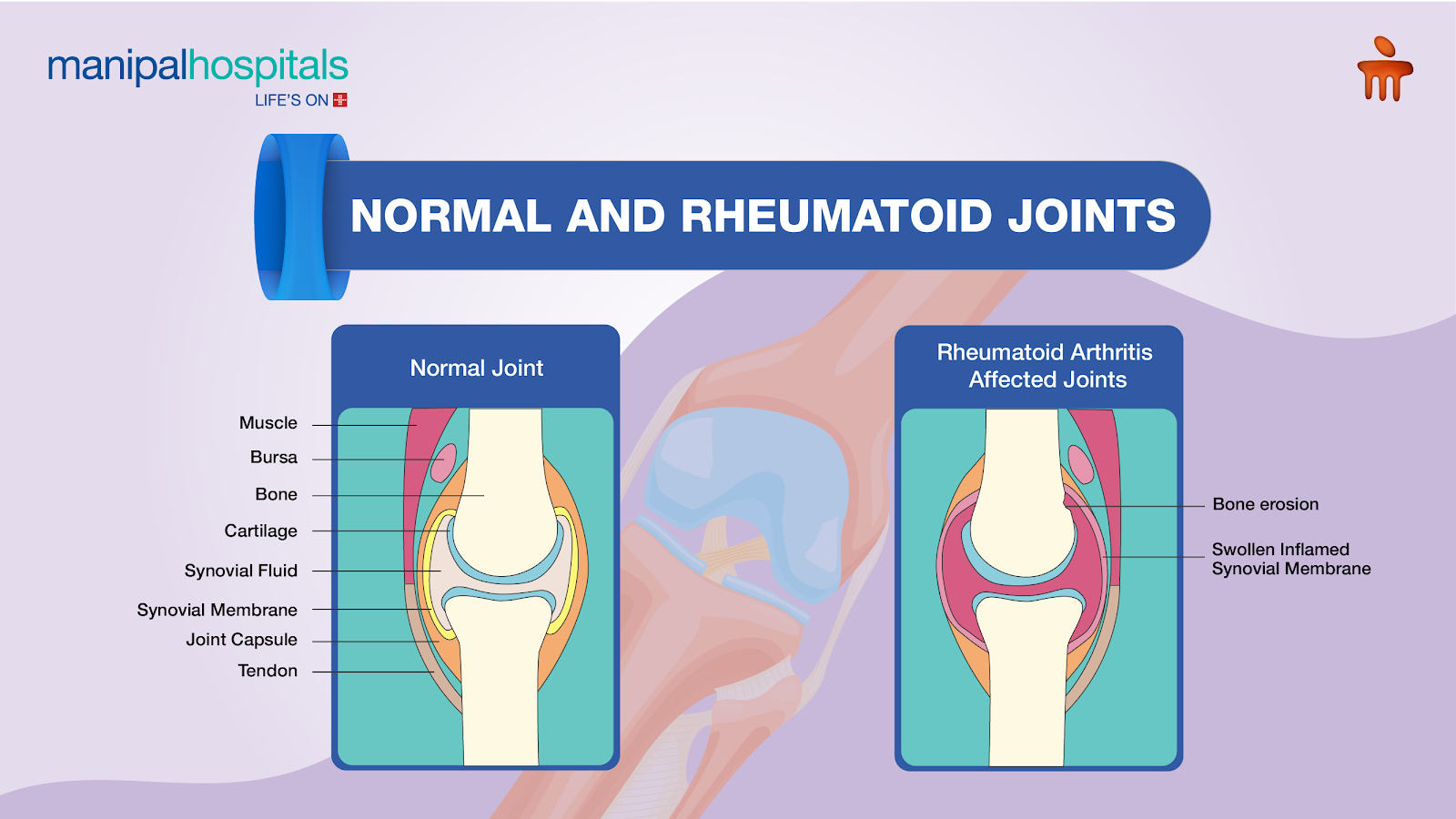 Signs of Rheumatoid Arthritis in Young Adults - Manipal Hospitals