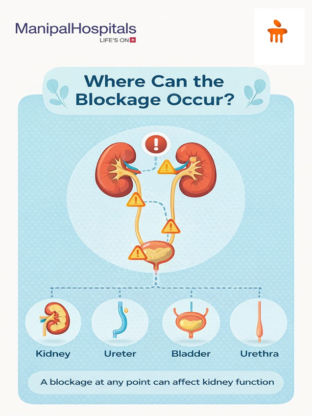 obstructive-uropathy-causes-symptoms-treatment-and-prevention