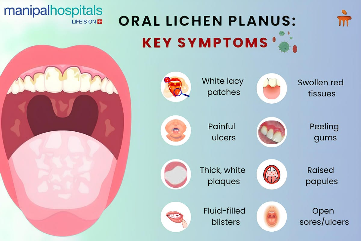 Oral Lichen Planus: Causes, Symptoms & Treatment Options