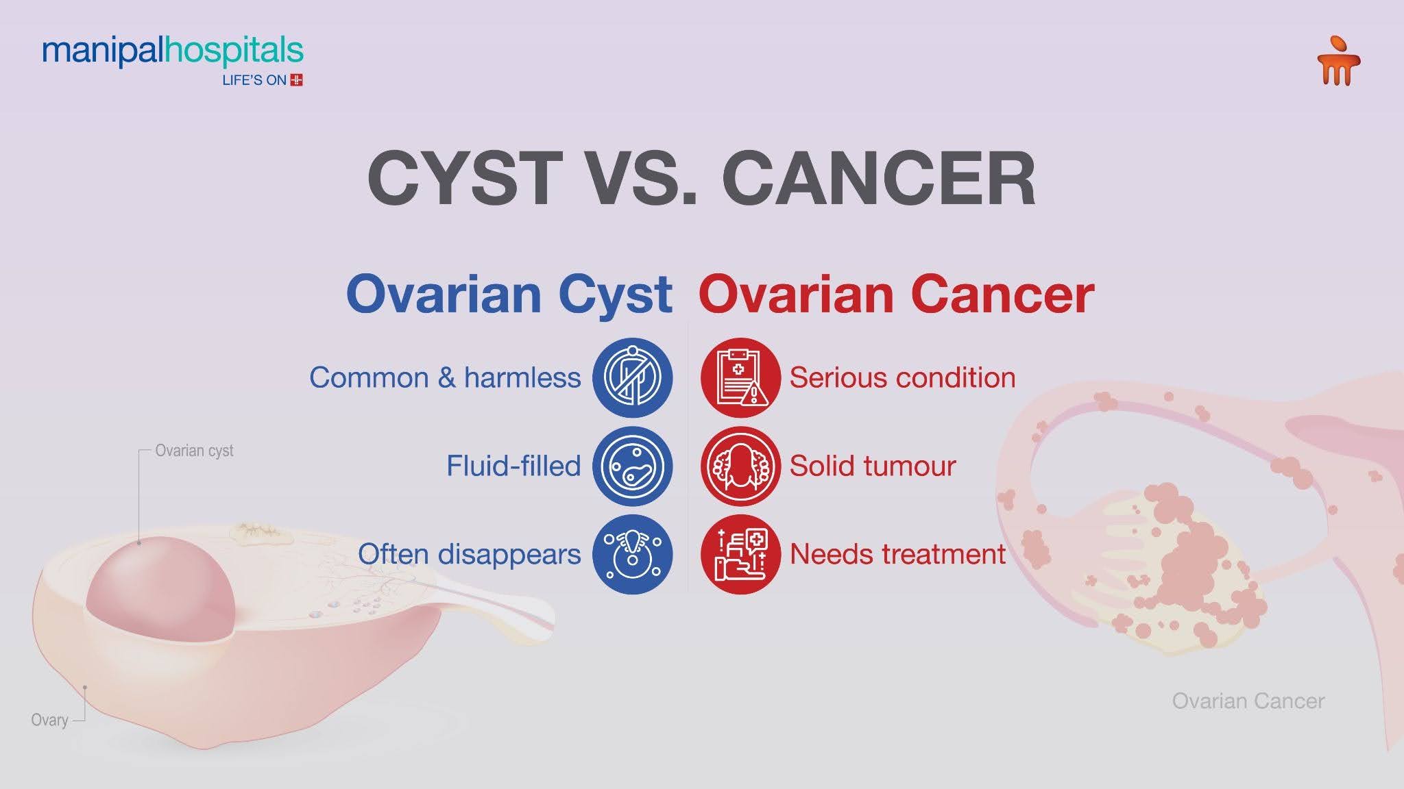 ovarian cancer stages