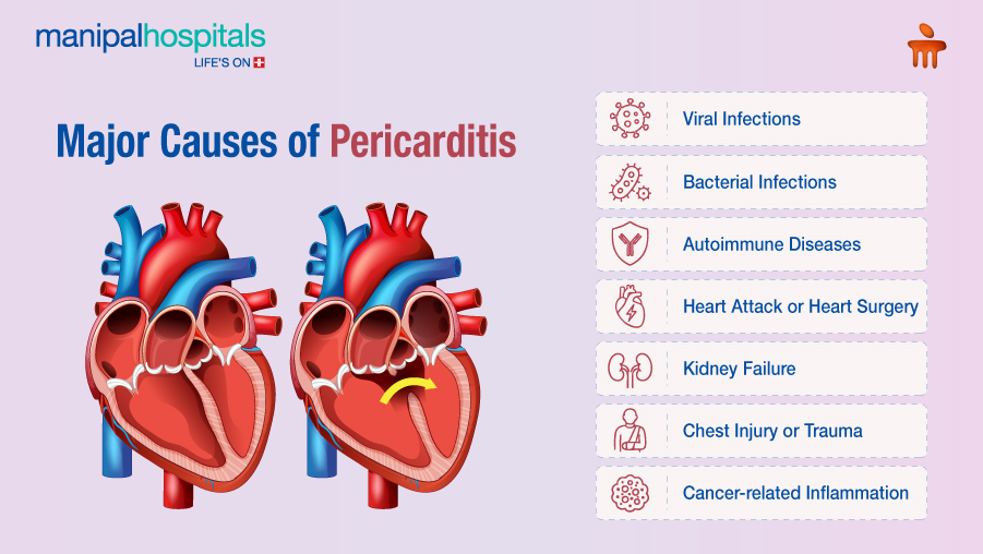 pericarditis symptoms