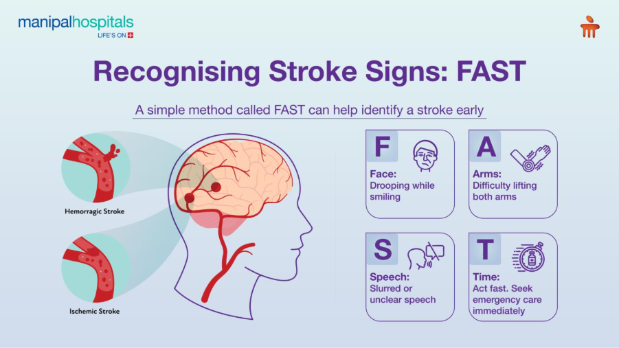 recognising-stroke-emergency-signs-you-should-not-ignore