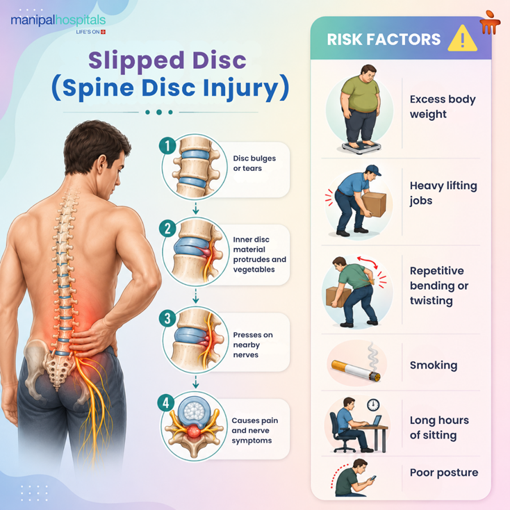 slipped-disc-causes-symptoms-when-to-see-doctor
