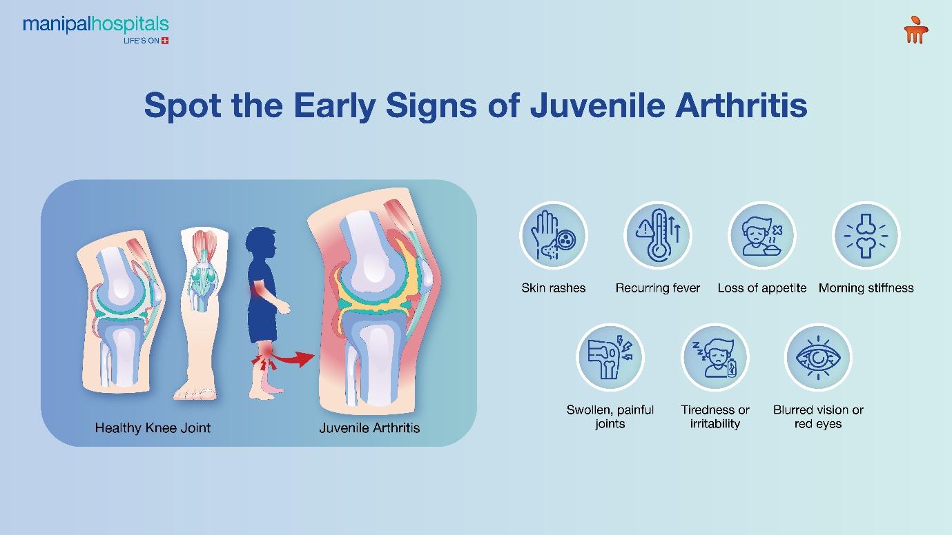 signs of early juvenile arthritis